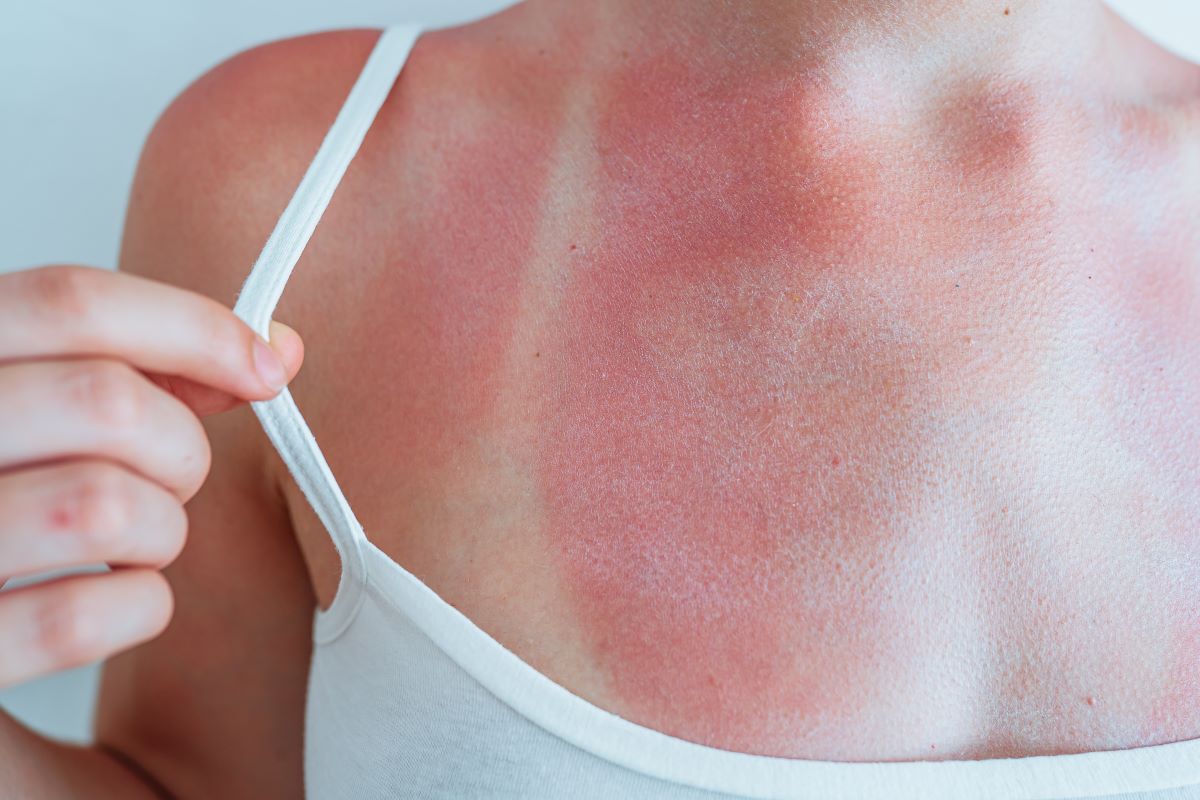 Sonnenbrand im Harz vermeiden und richtig behandeln – Tipps 